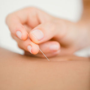 Akupunktio/dry needling 30 min